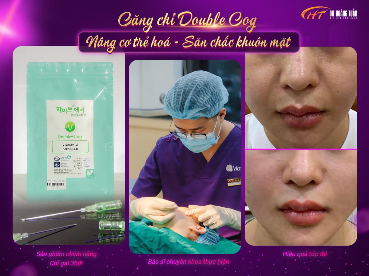 hình ảnh căng da mặt bằng chỉ